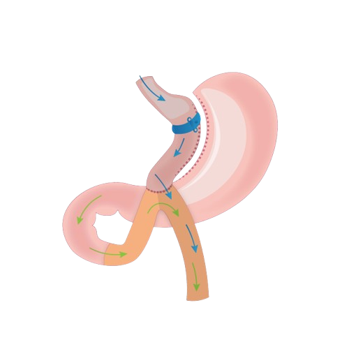 Minimally Invasive Pancreas Surgery