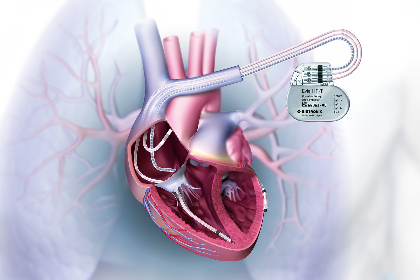 CRT Device Implantation: Cardiac Resynchronization Therapy
