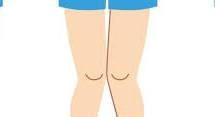 Bow Legs Correction Surgery
