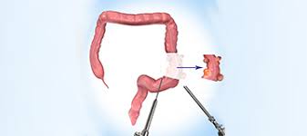 Minimally Invasive Colon Surgery
